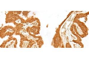 Immunohistochemistry of paraffin-embedded Human thyroid cancer tissue using GANC Polyclonal Antibody at dilution of 1:55(x200) (GANC anticorps)