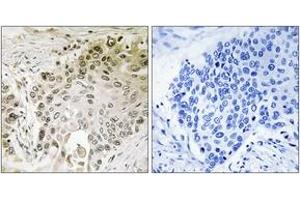 Immunohistochemistry analysis of paraffin-embedded human lung carcinoma, using RFX2 Antibody. (RFX2 anticorps  (AA 661-710))