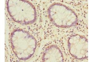Immunohistochemistry of paraffin-embedded human colon cancer using ABIN7159601 at dilution of 1:100