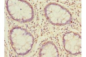 Immunohistochemistry of paraffin-embedded human colon cancer using ABIN7159601 at dilution of 1:100 (MSRB2 anticorps  (AA 10-182))