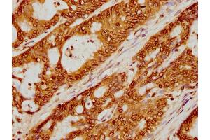 IHC image of nme1HU diluted at 1:5 and staining in paraffin-embedded human colon cancer performed on a Leica BondTM system.