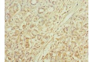 Immunohistochemistry of paraffin-embedded human pancreatic cancer using ABIN7146098 at dilution of 1:100