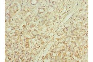 Immunohistochemistry of paraffin-embedded human pancreatic cancer using ABIN7146098 at dilution of 1:100 (MRC2 anticorps  (AA 120-300))