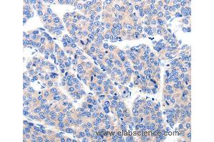 Immunohistochemistry of Human liver cancer using KCNH8 Polyclonal Antibody at dilution of 1:50 (KCNH8 anticorps)