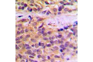 Immunohistochemical analysis of RAB11FIP1 staining in human prostate cancer formalin fixed paraffin embedded tissue section.