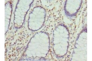 Immunohistochemistry of paraffin-embedded human colon cancer using ABIN7149288 at dilution of 1:100