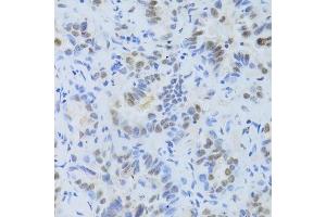 Immunohistochemistry of paraffin-embedded human lung cancer using SRSF1 Antibody.