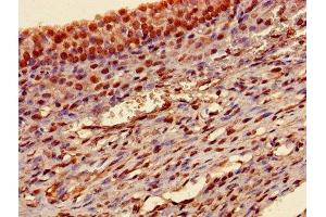 Immunohistochemistry of paraffin-embedded human ovarian cancer using ABIN7172847 at dilution of 1:100 (Transgelin anticorps  (AA 2-201))