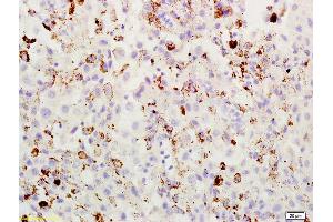 Formalin-fixed and paraffin embedded mouse melanoma labeled with Rabbit Anti ABCB5 Polyclonal Antibody, Unconjugated (ABIN731933) at 1:200 followed by conjugation to the secondary antibody and DAB staining (ABCB5 anticorps  (AA 841-883))