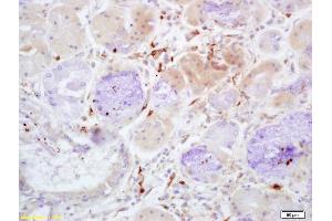 Formalin-fixed and paraffin embedded human lung carcinoma with labeled Anti-Properdin Polyclonal Antibody, Unconjugated (ABIN1386799) at 1:200, followed by conjugation to the secondary antibody and DAB staining (CFP anticorps  (AA 401-469))