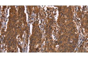 Immunohistochemistry of paraffin-embedded Human gastic cancer using HINT1 Polyclonal Antibody at dilution of 1:30 (HINT1 anticorps)