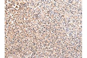 The image on the left is immunohistochemistry of paraffin-embedded Human prostate cancer tissue using ABIN7192170(RERE Antibody) at dilution 1/20, on the right is treated with synthetic peptide. (RERE anticorps)