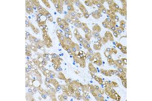 Immunohistochemistry of paraffin-embedded human liver injury using TOB2 antibody. (TOB2 anticorps)
