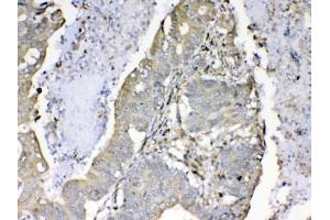 IHC testing of FFPE human rectal cancer tissue with Cyclophilin B antibody at 1ug/ml. (PPIB anticorps)