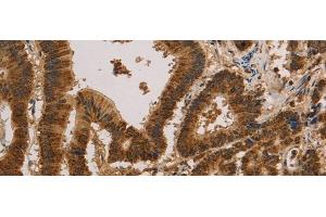 Immunohistochemistry of paraffin-embedded Human colon cancer tissue using CSNK2B Polyclonal Antibody at dilution of 1:30(x200)