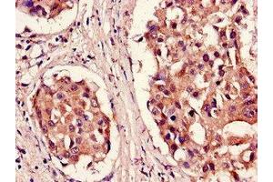 Immunohistochemistry of paraffin-embedded human breast cancer using ABIN7164982 at dilution of 1:100 (PSMB5 anticorps  (AA 106-188))