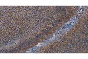 Immunohistochemistry of paraffin-embedded Human rectal cancer using P3H3 Polyclonal Antibody at dilution of 1:50 (LEPREL2 anticorps)