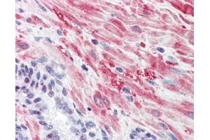 Immunohistochemistry with Anti-Glycogen Synthase antibody Tissue: Human Prostate Fixation: formalin-fixed, paraffin-embedded tissue Antigen retrieval: heat-induced Primary antibody: 5 µg/ml Staining: antibody as precipitated red signal with a hematoxylin purple nuclear counterstain.