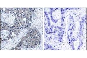 Immunohistochemistry analysis of paraffin-embedded human breast carcinoma, using eIF4E (Phospho-Ser209) Antibody. (EIF4E anticorps  (pSer209))