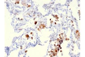 Formalin-fixed, paraffin-embedded human Lung Adenocarcinoma stained with Napsin A Mouse Monoclonal Antibody (NAPSA/3306). (NAPSA anticorps  (AA 189-299))