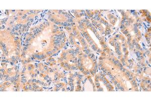 Immunohistochemistry of paraffin-embedded Human thyroid cancer tissue using CD109 Polyclonal Antibody at dilution 1:30 (CD109 anticorps)