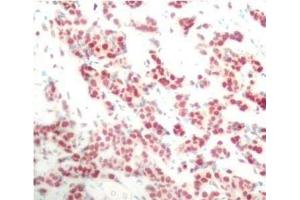Immunohistochemistry of paraffin-embedded Human breast carcinoma using Phospho-NFkB p100(S866) Polyclonal Antibody