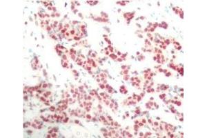 Immunohistochemistry of paraffin-embedded Human breast carcinoma using Phospho-NFkB p100(S866) Polyclonal Antibody (NFKB2 anticorps  (pSer866))