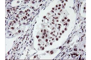 Immunohistochemical staining of paraffin-embedded Carcinoma of Human lung tissue using anti-RNF113B mouse monoclonal antibody. (RNF113B anticorps)