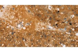 Immunohistochemistry of paraffin-embedded Human breast cancer using TBC1D4 Polyclonal Antibody at dilution of 1:40