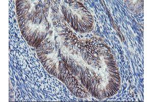 Immunohistochemical staining of paraffin-embedded Adenocarcinoma of Human endometrium tissue using anti-DTNB mouse monoclonal antibody. (Dystrobrevin beta anticorps)