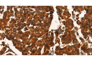 Immunohistochemistry of paraffin-embedded Human breast cancer using CUEDC2 Polyclonal Antibody at dilution of 1:50