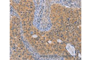 Immunohistochemistry of Human cervical cancer using BRS3 Polyclonal Antibody at dilution of 1:50