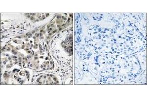 Immunohistochemistry analysis of paraffin-embedded human breast carcinoma, using USP6NL Antibody. (USP6NL anticorps  (AA 451-500))