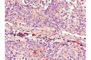 Immunohistochemistry of paraffin-embedded human cervical cancer using  at dilution of 1:100 (CDKN2A anticorps  (AA 1-86))