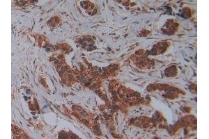 Detection of PLAP in Human Breast cancer Tissue using Polyclonal Antibody to Phospholipase A2 Activating Protein (PLAP)