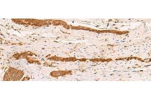 Immunohistochemistry of paraffin-embedded Human liver cancer tissue using ZFYVE27 Polyclonal Antibody at dilution of 1:50(x200) (ZFYVE27 anticorps)