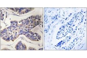 Immunohistochemistry analysis of paraffin-embedded human breast carcinoma tissue, using TAOK1 Antibody. (TAO Kinase 1 (TAOK1) (AA 431-480) anticorps)