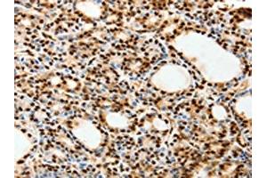 The image on the left is immunohistochemistry of paraffin-embedded Human thyroid cancer tissue using ABIN7192627(SPATA20 Antibody) at dilution 1/70, on the right is treated with synthetic peptide. (SPATA2 anticorps)