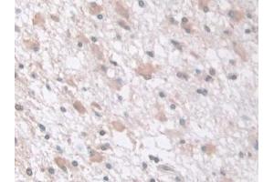 Detection of tPK1 in Human Glioma Tissue using Polyclonal Antibody to Tau-Protein Kinase 1 (tPK1)