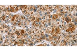 Immunohistochemistry of paraffin-embedded Human liver cancer tissue using CYP27A1 Polyclonal Antibody at dilution 1:50 (CYP27A1 anticorps)