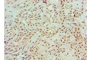 Immunohistochemistry of paraffin-embedded human breast cancer using ABIN7143157 at dilution of 1:100 (ASCC3 anticorps  (AA 1-111))