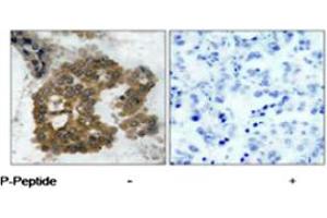 Immunohistochemical analysis of paraffin-embedded human lung carcinoma tissue using AKT2 (phospho S474) polyclonal antibody . (AKT2 anticorps  (pSer474))
