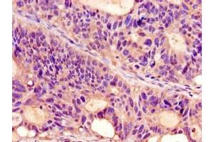 Immunohistochemistry of paraffin-embedded human colon cancer using ABIN7164713 at dilution of 1:100 (Prokineticin Receptor 2 anticorps  (AA 1-45))