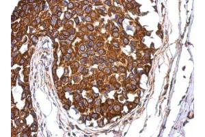 IHC-P Image Immunohistochemical analysis of paraffin-embedded human breast cancer, using Aladin, antibody at 1:500 dilution.