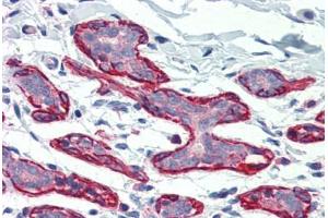 Human Breast (formalin-fixed, paraffin-embedded) stained with DLG4 antibody ABIN396947 at 5 ug/ml followed by biotinylated goat anti-rabbit IgG secondary antibody ABIN481713, alkaline phosphatase-streptavidin and chromogen.