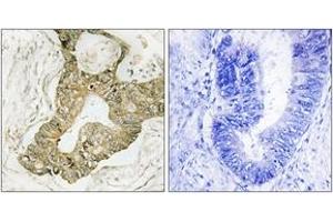 Immunohistochemistry analysis of paraffin-embedded human breast carcinoma tissue, using p90 RSK (Ab-380) Antibody.