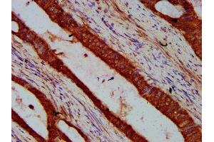 IHC image of ABIN7169218 diluted at 1:600 and staining in paraffin-embedded human colon cancer performed on a Leica BondTM system.