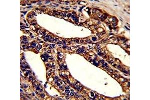 IHC analysis of FFPE human prostate carcinoma stained with ORAI1 antibody