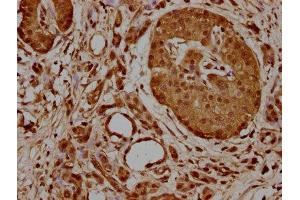 IHC image of ABIN7154863 diluted at 1:700 and staining in paraffin-embedded human pancreatic cancer performed on a Leica BondTM system. (HSP70 1A anticorps  (AA 291-641))