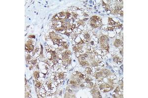 Immunohistochemistry of paraffin-embedded human liver cancer using MT2A Rabbit pAb (ABIN3015841, ABIN3015842, ABIN3015843 and ABIN6219186) at dilution of 1:150 (40x lens). (MT2A anticorps  (AA 1-61))
